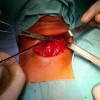 thyroide_chirurgie.jpg